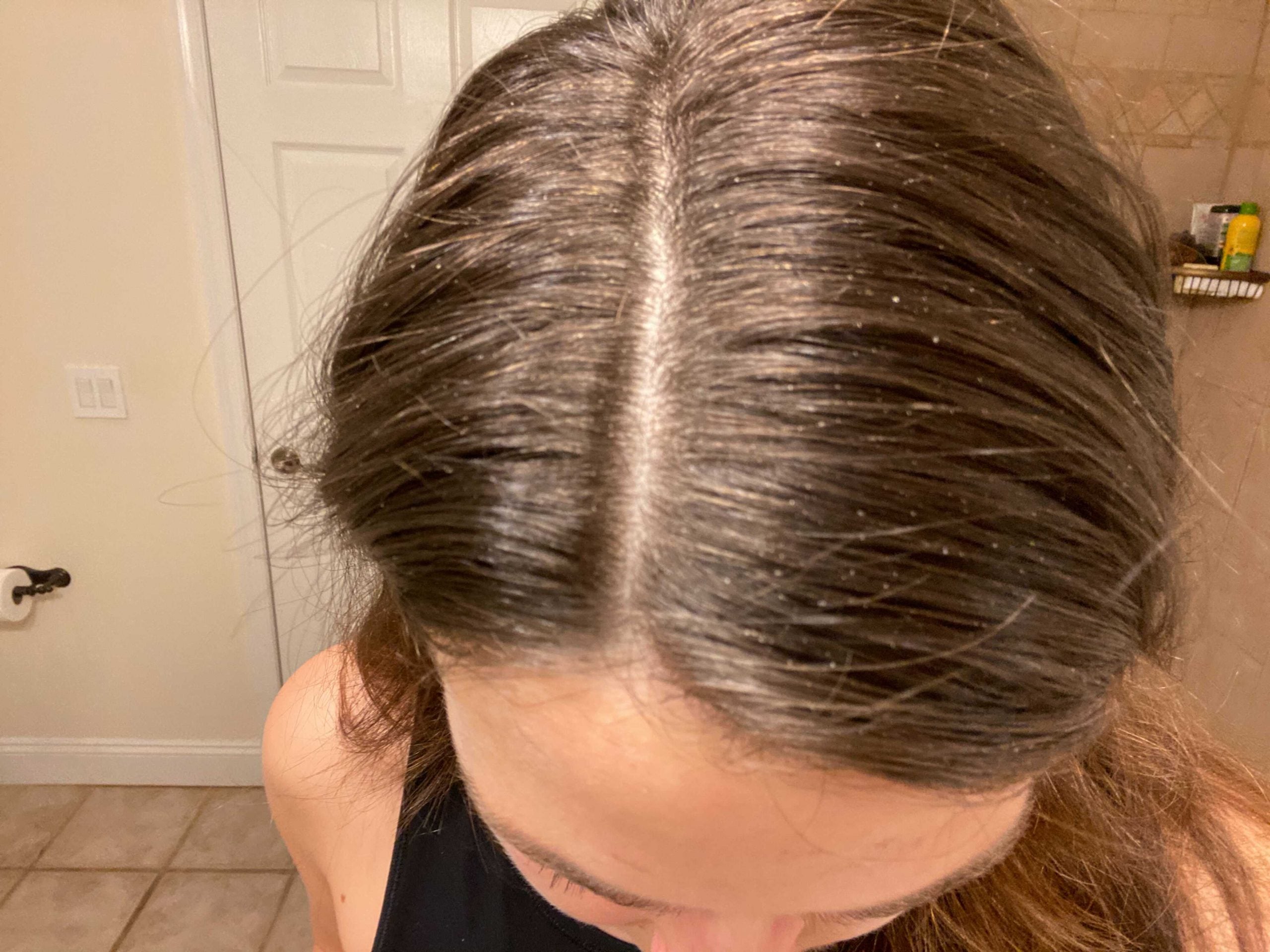 photo of flaky scalp and hair